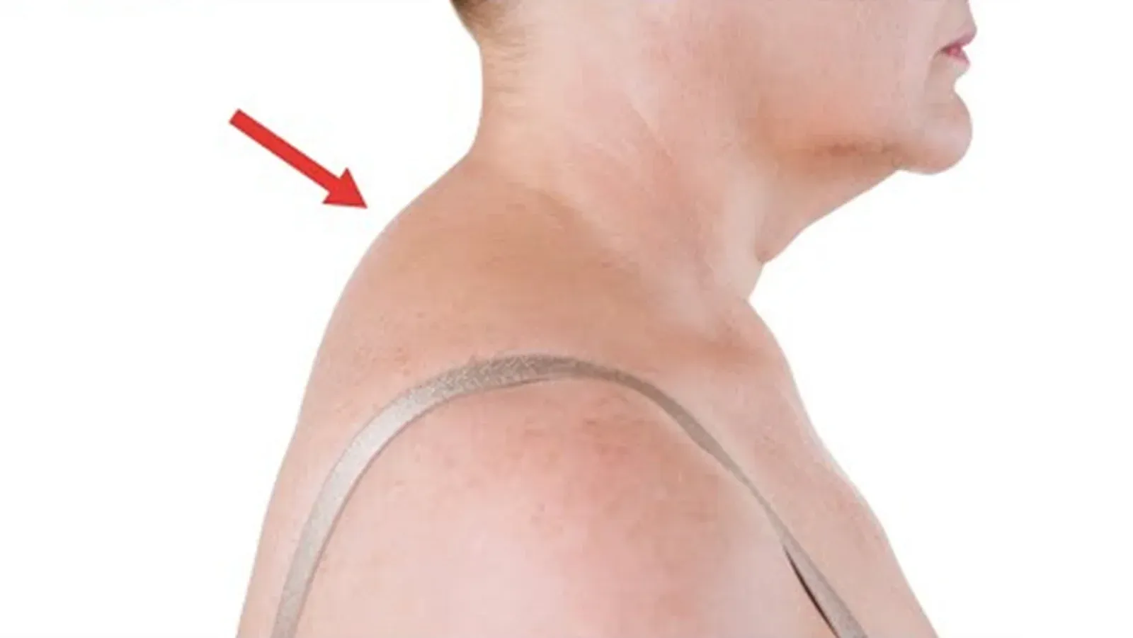 Can a Chiropractor Fix Neck Hump?